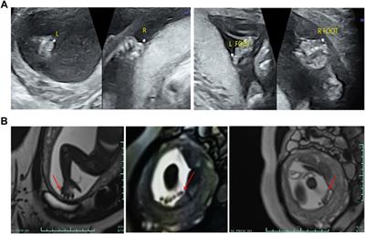 Case Report: Prenatal Diagnosis of Postaxial Polydactyly With Bi-Allelic Variants in Smoothened (SMO)